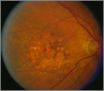 enfermedades de la retina