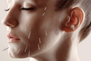 acupuntura en la parálisis facial