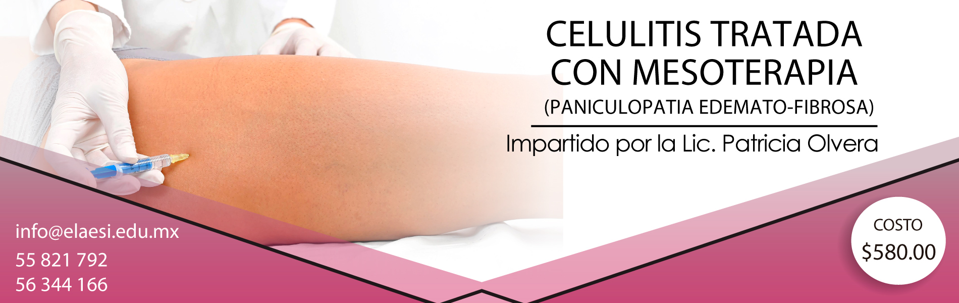 CELULITIS TRATADA CON MESOTERAPIA CDMX - ELAESI