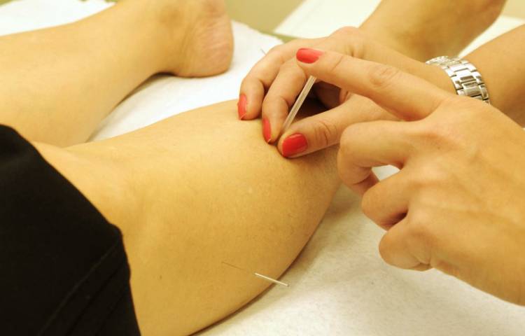 La acupuntura como método para tratar las várices