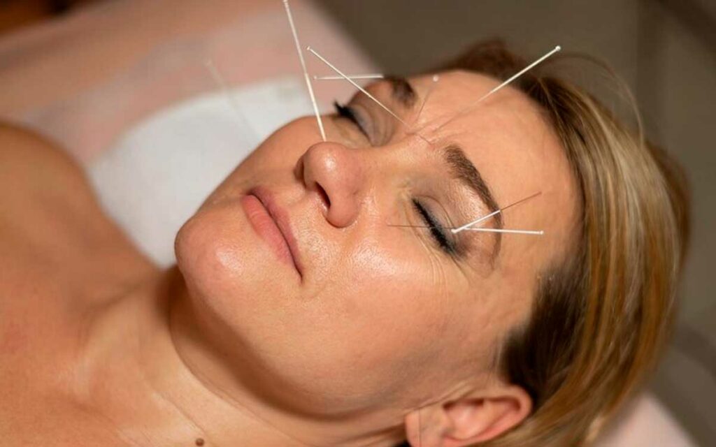 aplicacion de acupuntura cdmx