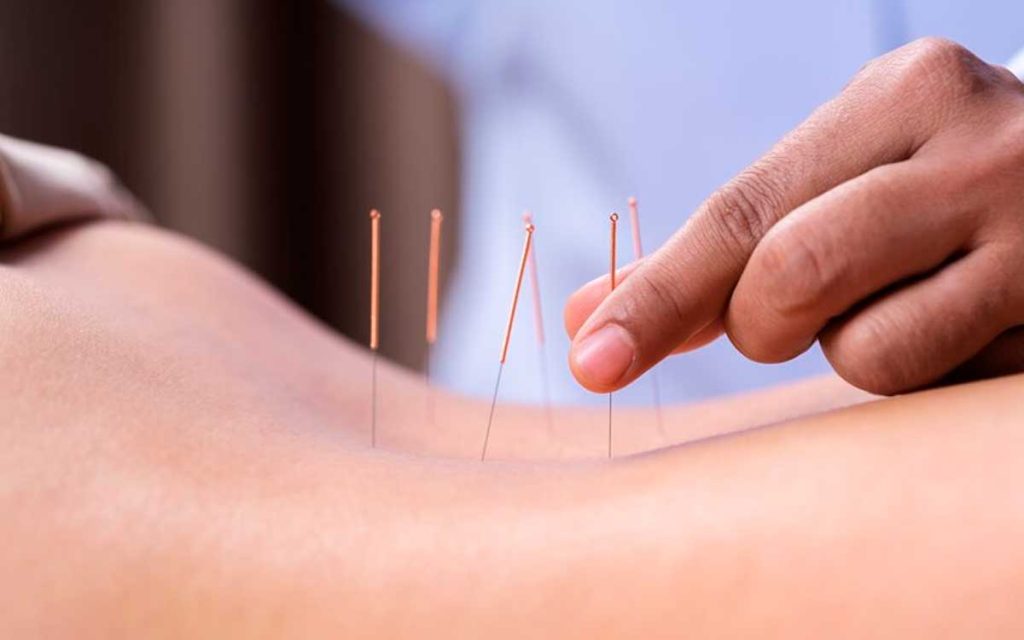 agujas de acupuntura en espalda de paciente