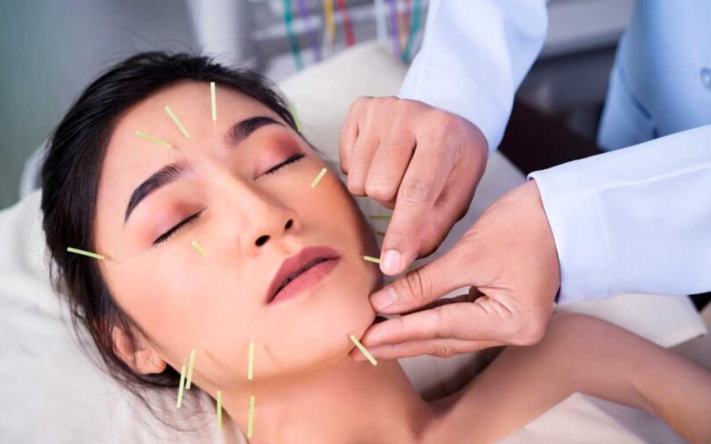 persona con agujas de acupuntura facial