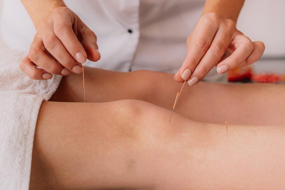 terapia de beneficios y la función de la acupuntura como parte de la medicina alternativa
