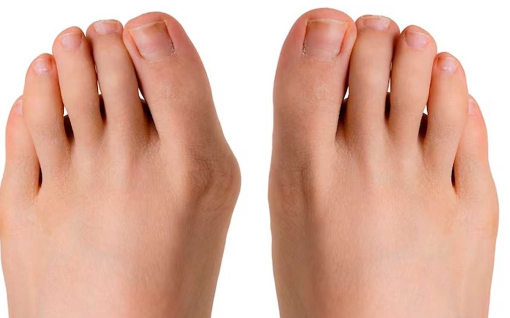 pies con hallux valgus podologia